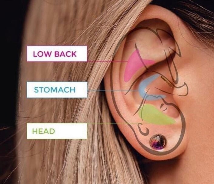 Migraines/Headaches Mini Ear Seed Kit